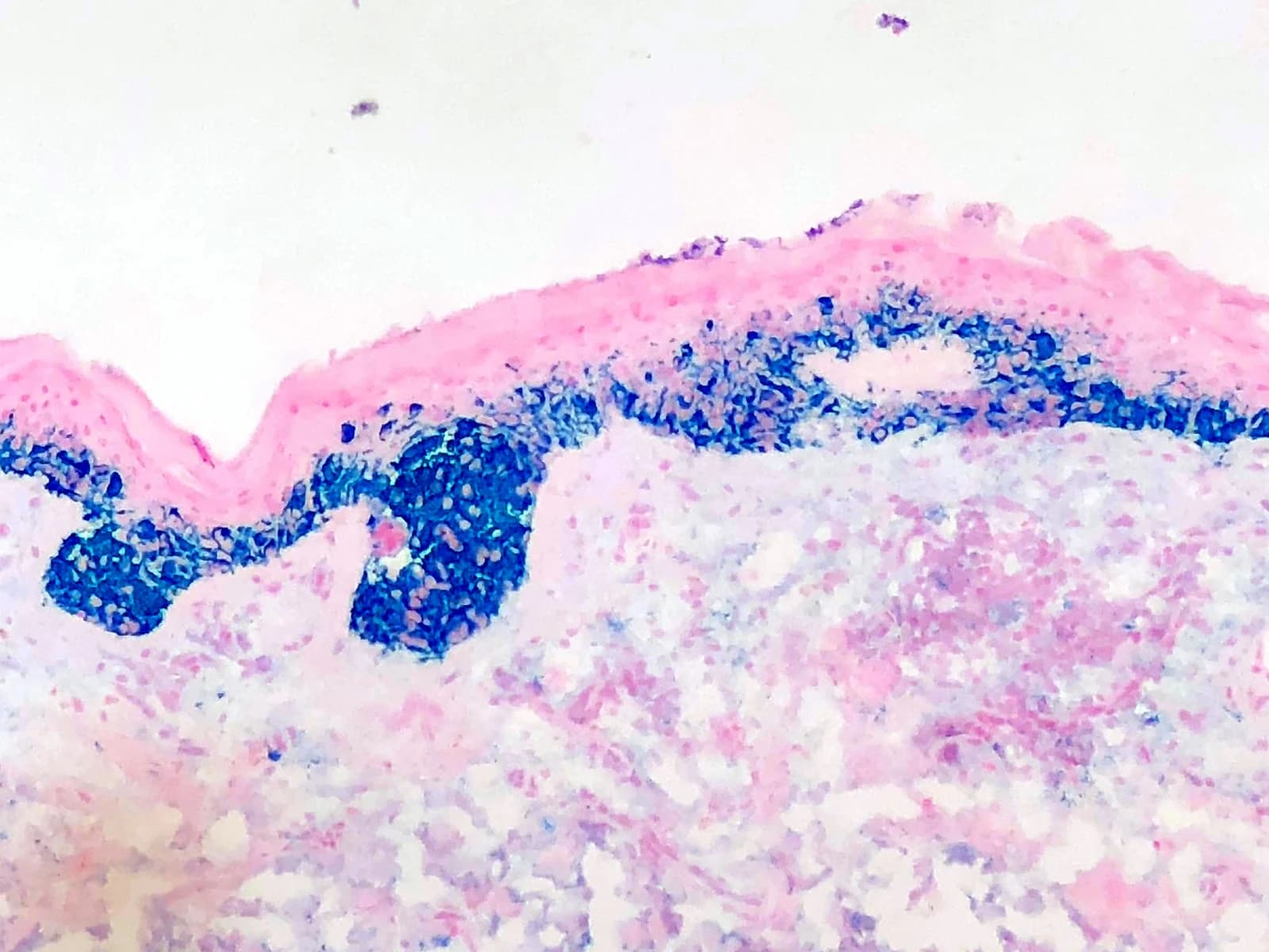MART-1 immunostain photographed through the microscope: melanoma cells stained blue beneath the pink epidermis