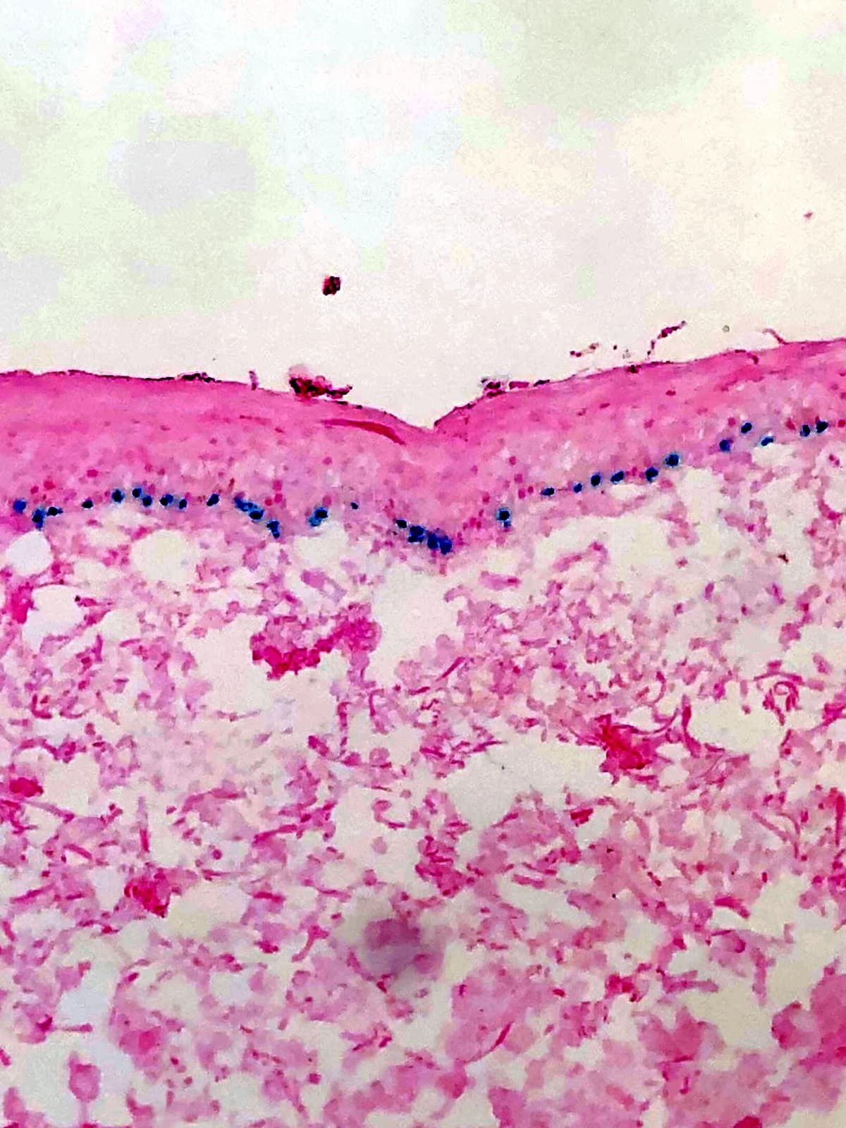 SOX10 immunostain photographed through the microscope: melanocyte nuclei stained blue in a line along the epidermal underside