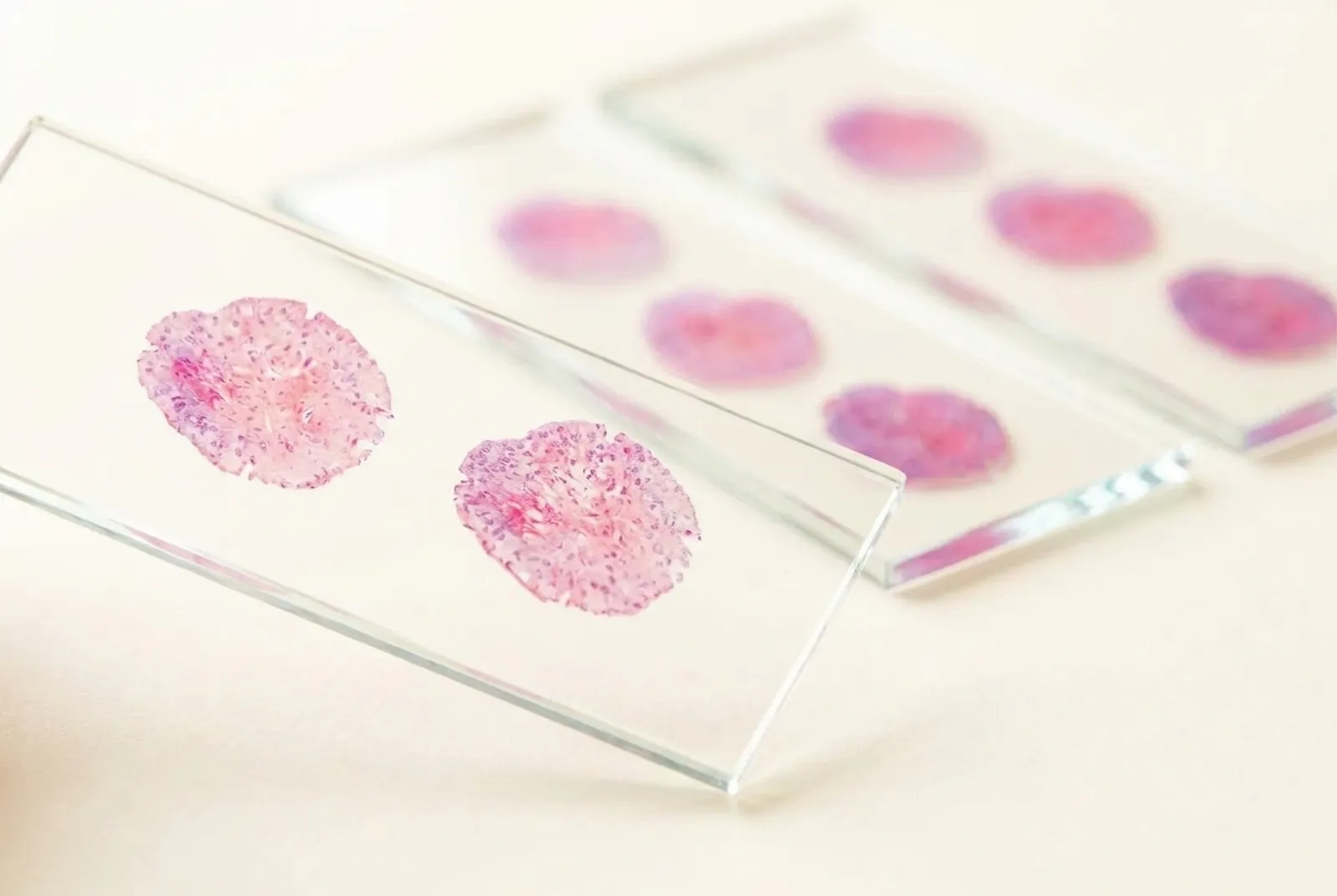 Glass slides with H&E-stained Mohs frozen sections — pink tissue discs on bright glass